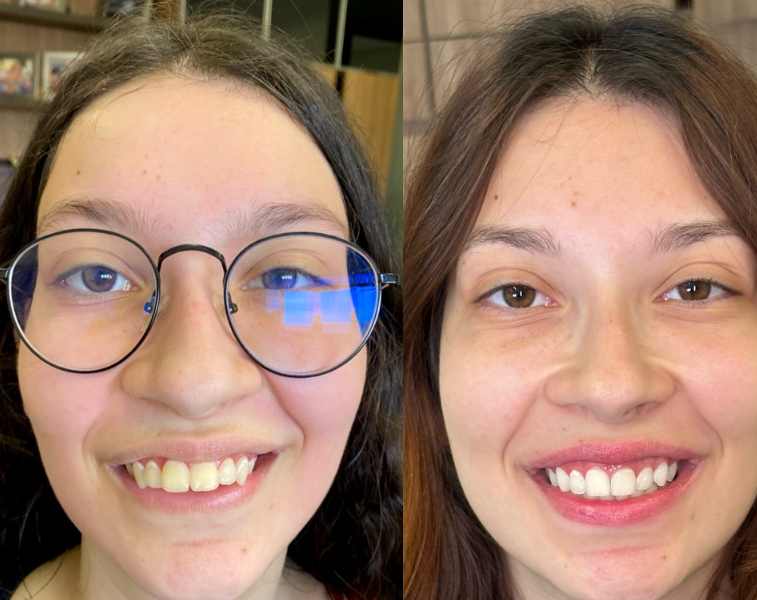 Antes e depois — procedimento 5